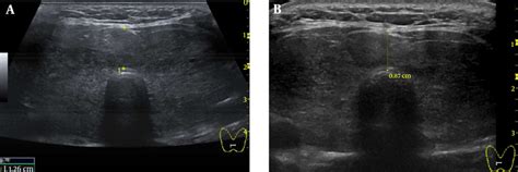 A Ultrasonography Of The Thyroid Revealed A Diffusely Enlarged Thyroid