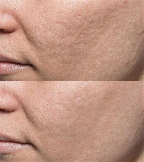 Bellafill® For Acne Scars And Nasolabial Folds Bloomfield Hills