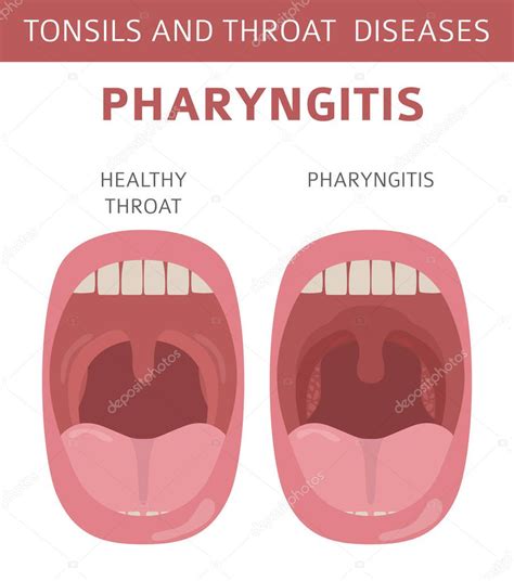 Amígdalas Y Enfermedades De La Garganta Síntomas De Faringitis