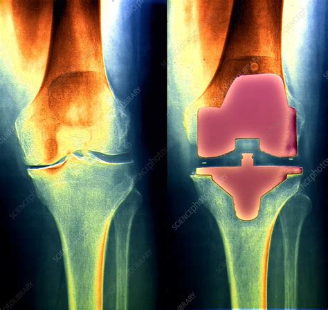 Knee Replacement X Ray Stock Image C0530095 Science Photo Library