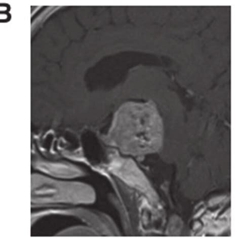 A Preoperative T1 Weighted Axial Magnetic Resonance Imaging Mri With