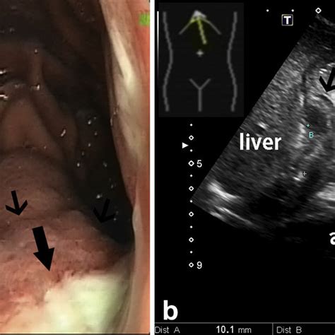 A Typical Malignant Gastric Ulcer A Endoscopic View Showing A Download Scientific Diagram