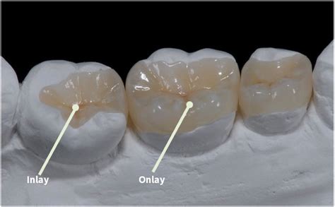 Dental Onlays And Inlays In Beckenham Kent Beckenham Dental Centre