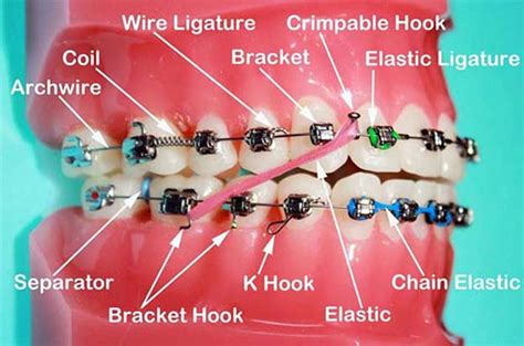 Parts Of Braces Bordentown Braces