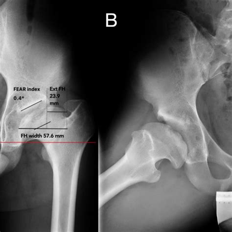 Anteroposterior A And Axial B Radiographs Of Both Hips After The