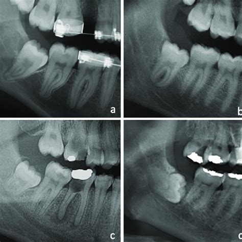 Pdf Marginal Bone Loss In The Second Molar Related To Impacted