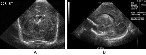 Impact Of Low Grade Periventricular Intraventricular Hemorrhage On