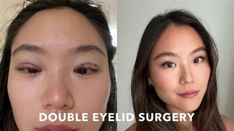 I Got Double Eyelid Surgery In Korea Experience Recovery Before After Youtube