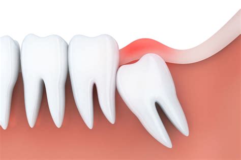 What Is A Partially Erupted Wisdom Tooth Dc Dental Spa