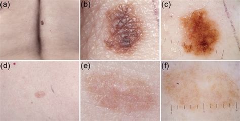 Light Colored Melanoma Pictures