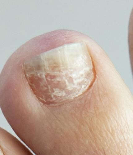 White Spots On Toenails Fungus Images And Photos Finder