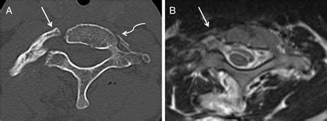 Cervical Ribs Identification On Mri And Clinical Relevance Clinical