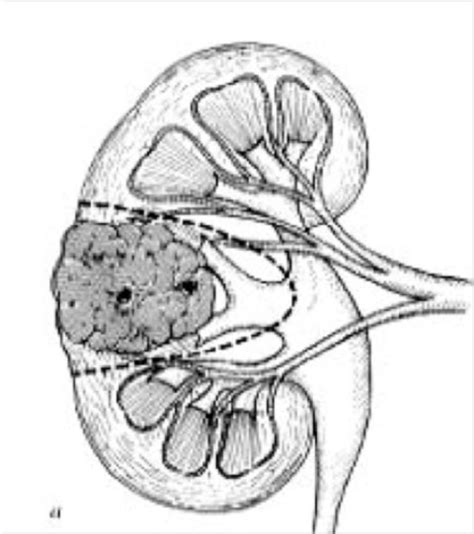 Cancer Rein 1 Urologie Marseille