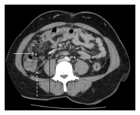 A Axial Ct With Intravenous Contrast The Appendix Is Seen Anterior