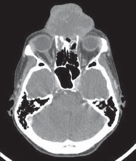 Contrast Enhanced Skull Computed Tomography Axial Section Demonstrate