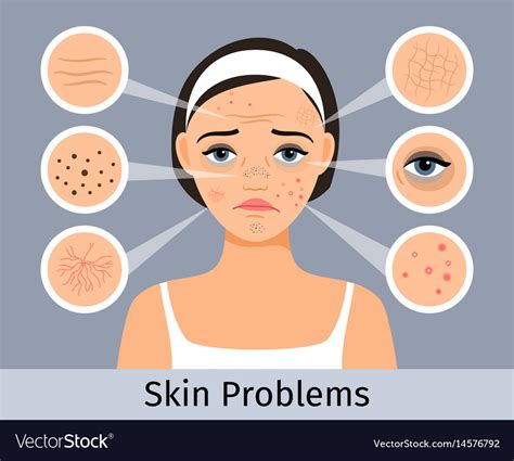 Girl Face With Skin Problems Royalty Free Vector Image