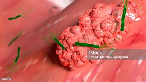 Tumor De Estómago Causada Por H Pylori Foto De Stock Y Más Banco De