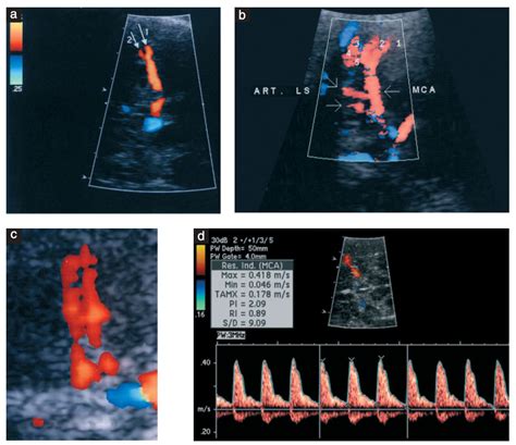 Middle Cerebral Artery Doppler For Fetal Anemia Department Of