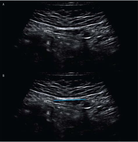 Ultrasound Imaging In Postpartum Women With Diastasis Recti Intrarater
