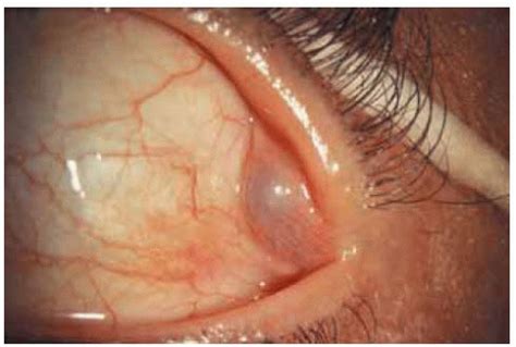 Lacrimal Duct Cyst