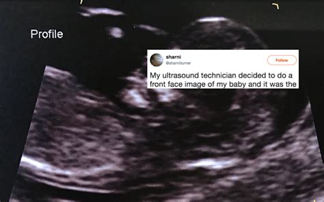This Viral Photo Of A Moms Terrifying Sonogram Has People Shook