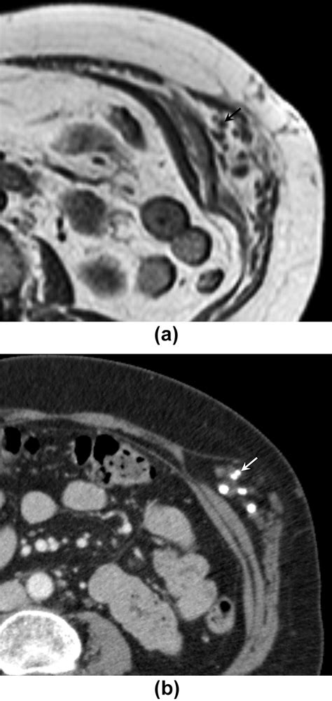 Soft Tissue Masses In The Abdominal Wall Clinical Radiology