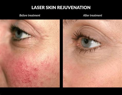 The Difference Between Laser Skin Rejuvenation And Skin Tightening
