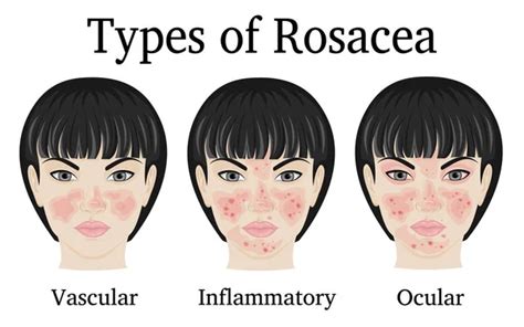 Rosacea Therapy Imágenes Vectoriales Gráfico Vectorial De Rosacea