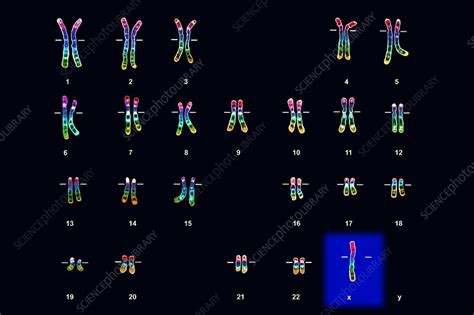 Turner S Syndrome Karyotype Female Stock Image C Science Photo Library