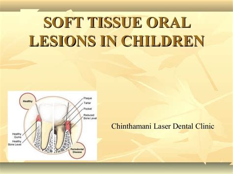 Soft Tissue Oral Lesions In Children