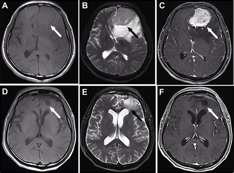 Frontiers The Treatment Outcomes Of Olfactory Neuroblastoma Patients