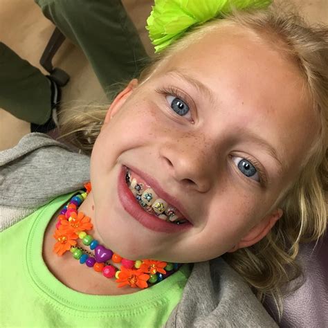 Awasome Best Braces Colors To Get For Summer Ideas