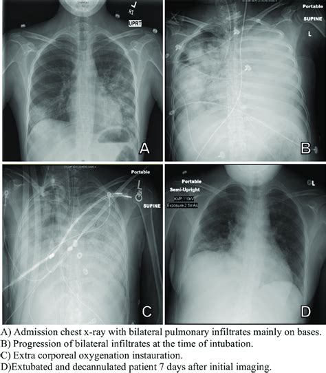 Chest X Ray On Admission Showing Bilateral Pulmonary Infiltration And