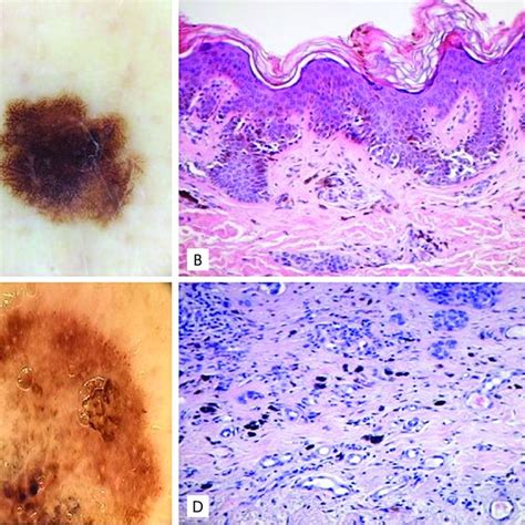 Dermoscopy Of An Early Lentigo Maligna Characterized By Asymmetrically