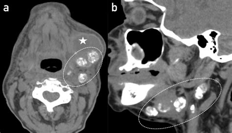 Example Of Calcified Lymph Nodes After Radiation Therapy Ct Axial A