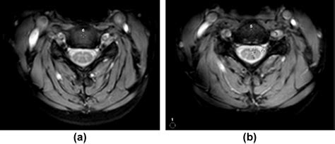 Mri Of The Cervical Spine With 3d Gradient Echo Sequence At 3 T