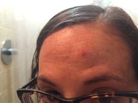 Big Pimple Under Skin Forehead