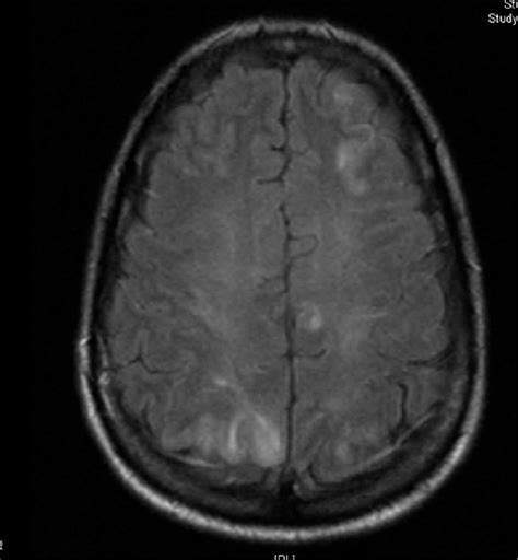Brain Mri Shows White Spot