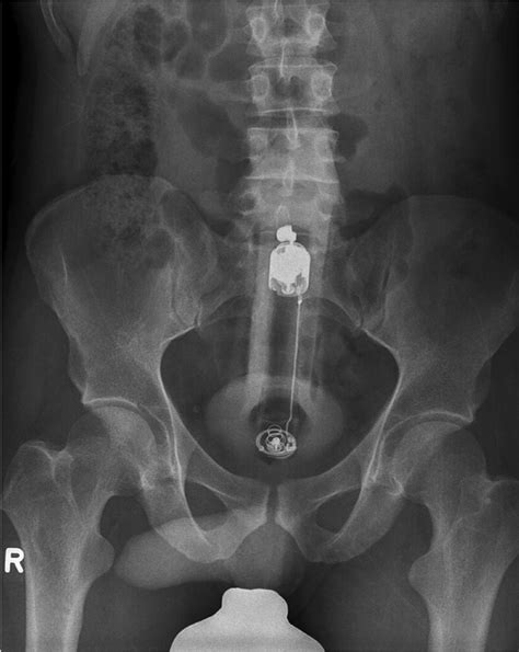 Surgical Management Of Rectal Foreign Bodies A 10 Year