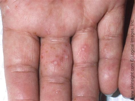 Skin Disease Types Vesicular Hand Dermatitis Skin Disease Type Sexiz Pix