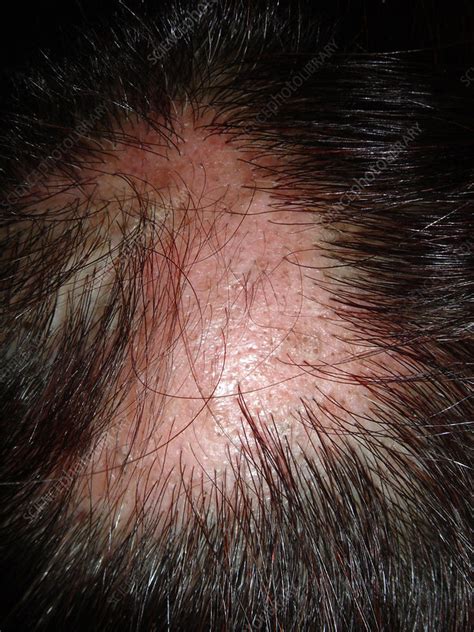 Alopecia Areata In Lupus Erythematosus Stock Image C0549599