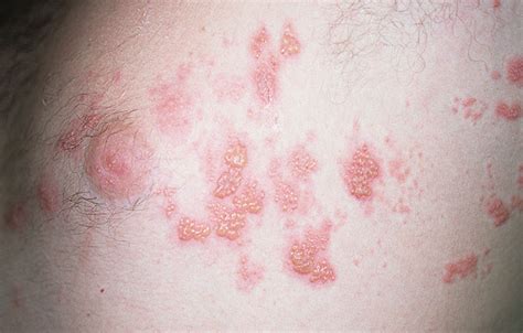 Stop application of oil on the skin. herpes rash picture - pictures, photos