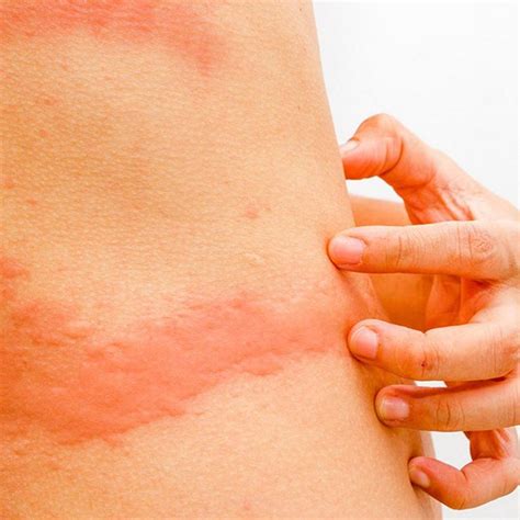 The 25 Best Types Of Rashes Ideas On Pinterest Rash Types Rashes In