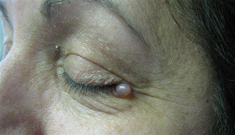 Derm Dx Cystic Papule Near The Eye Clinical Advisor