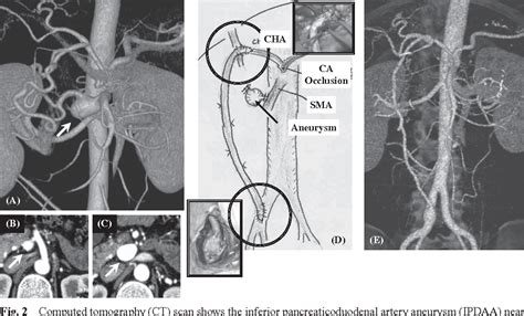 Anterior Superior Pancreaticoduodenal Artery Semantic Scholar