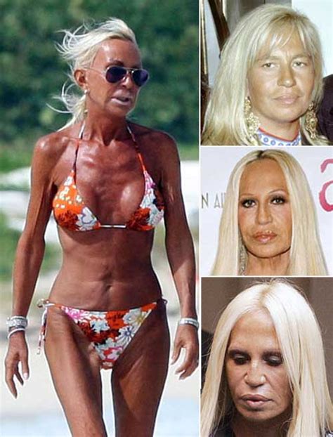 Donatella Versace Plastic Surgery Disaster