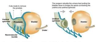 Open Radical Prostatectomy Gold Coast Urology