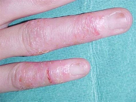 Dermatite Delle Mani