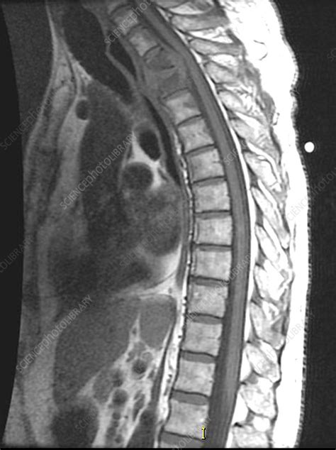 Spinal Infection Mri Stock Image C0271763 Science Photo Library