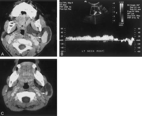 Cystic Hygroma Of The Neck Association With A Growing Venous Aneurysm